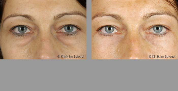 Ästhetische Chirurgie Unterlidkorrektur (Unterlidblepharoplastik